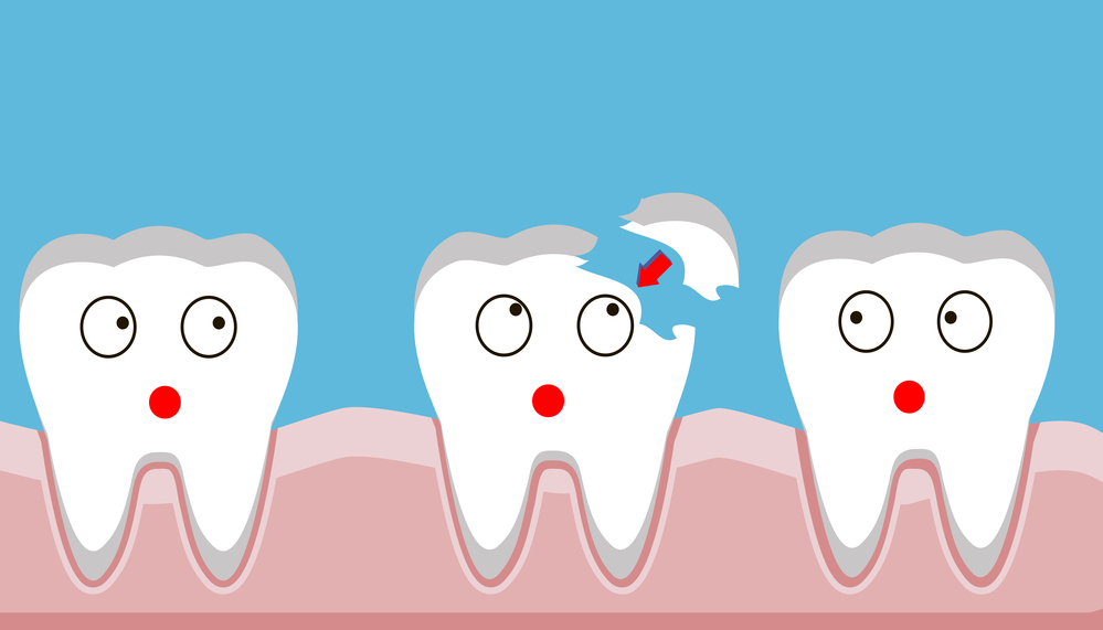 É possível arrumar os dentes depois dos 50 anos? 2 Dente quebrado 3