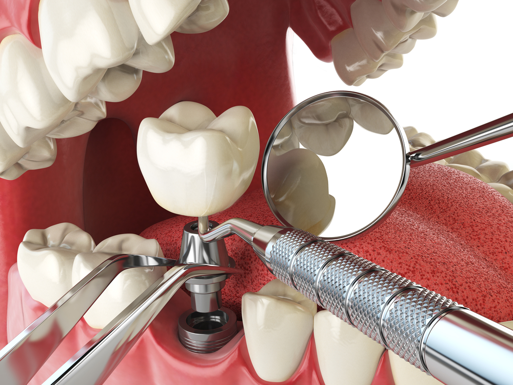 É possível arrumar os dentes depois dos 50 anos? 4 implante